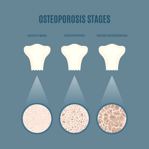 Osteoporosis Stages