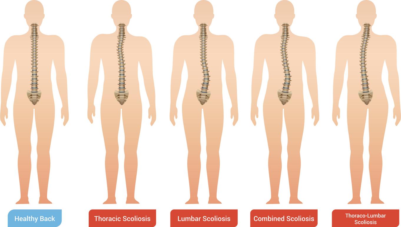 An infogarphic defining a healthy back of a human compared to Thoracic Scoliosis, Lumbar Scoliosis, Combined Scoliosis and Thoraco-Lumbar Scoliosis