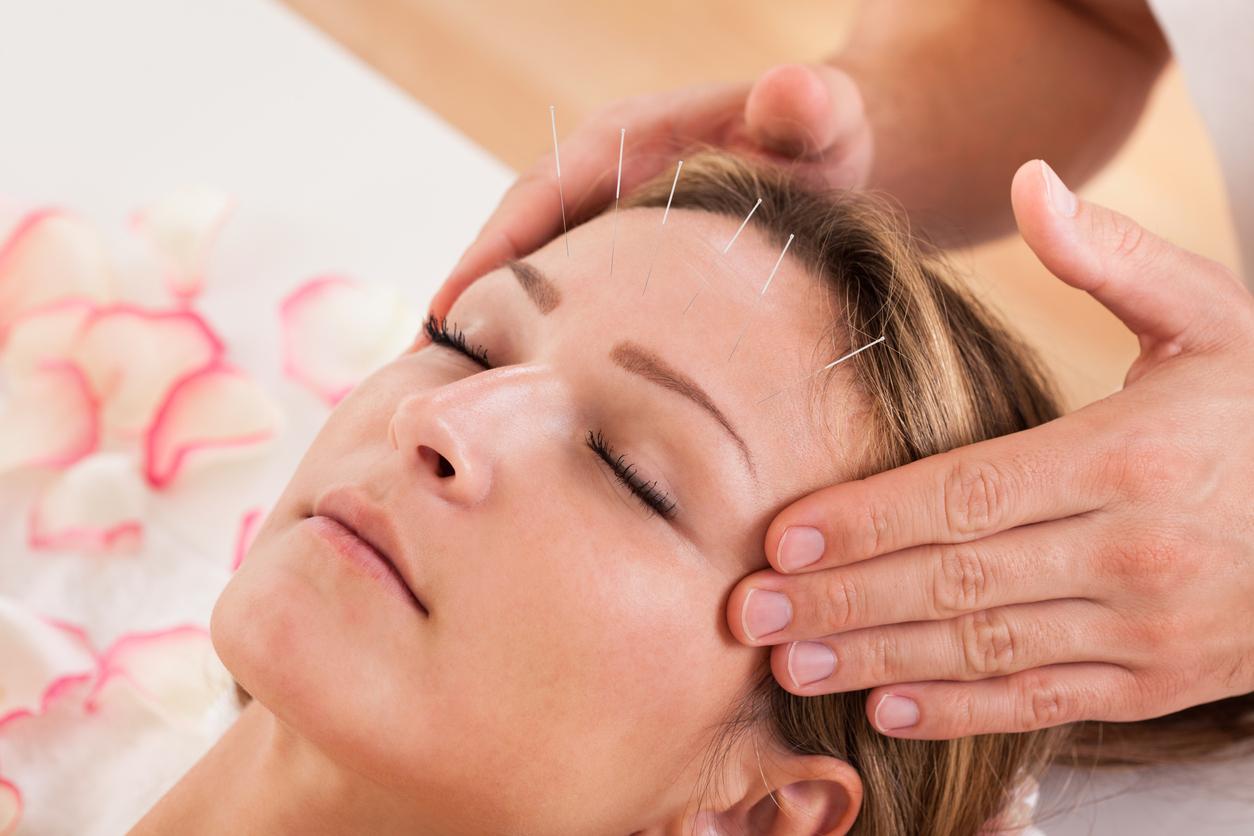 Acupuncture treatment on a woman's forehead, penetrating the skin with sterile metallic needles